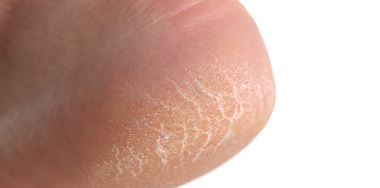 Cracked Heels