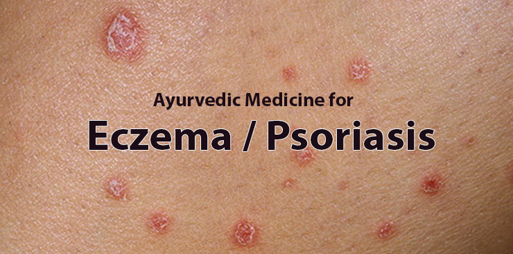 ayurvedic medicine for eczema/psoriasis