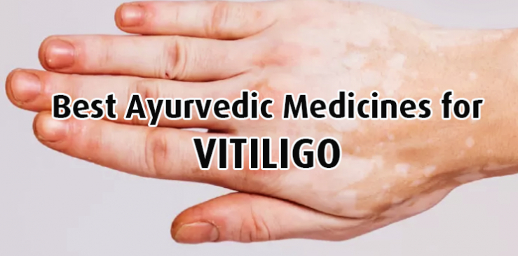 best ayurvedic medicines for vitiligo